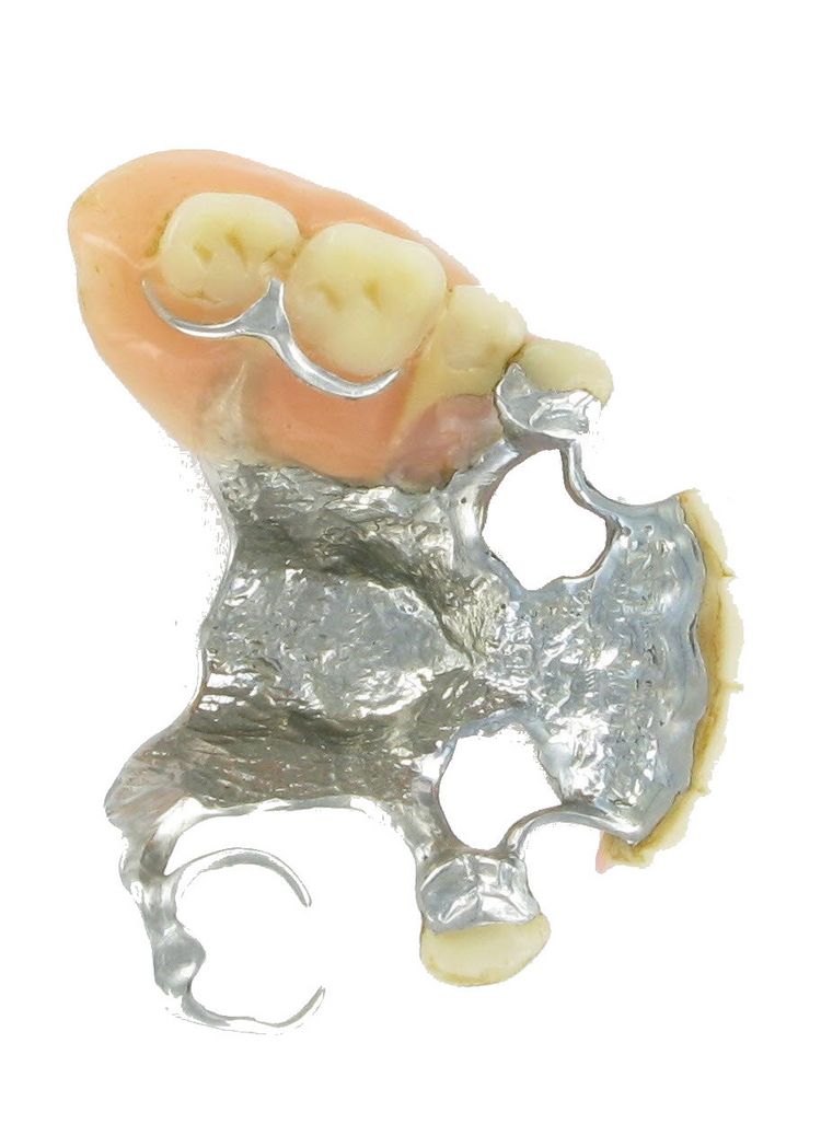 Spange/Prothese Spange/Prothese