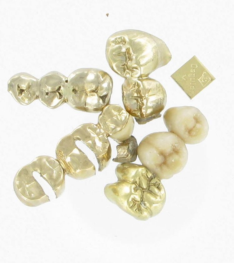 Goldfarbenes Zahngold Goldfarbenes Zahngold